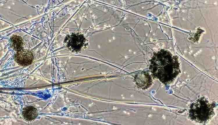 ब्लैक फंगस ने आँत में किया छेद, दिल्ली में सामने आया मामला