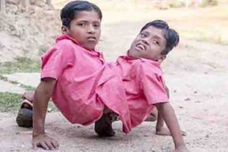 छत्तीसगढ़: चर्चित जुड़वा भाई शिवनाथ और शिवराम की मौत