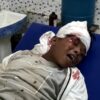 सहदेव दिरदो सड़क हादसे में बुरी तरह जख्मी